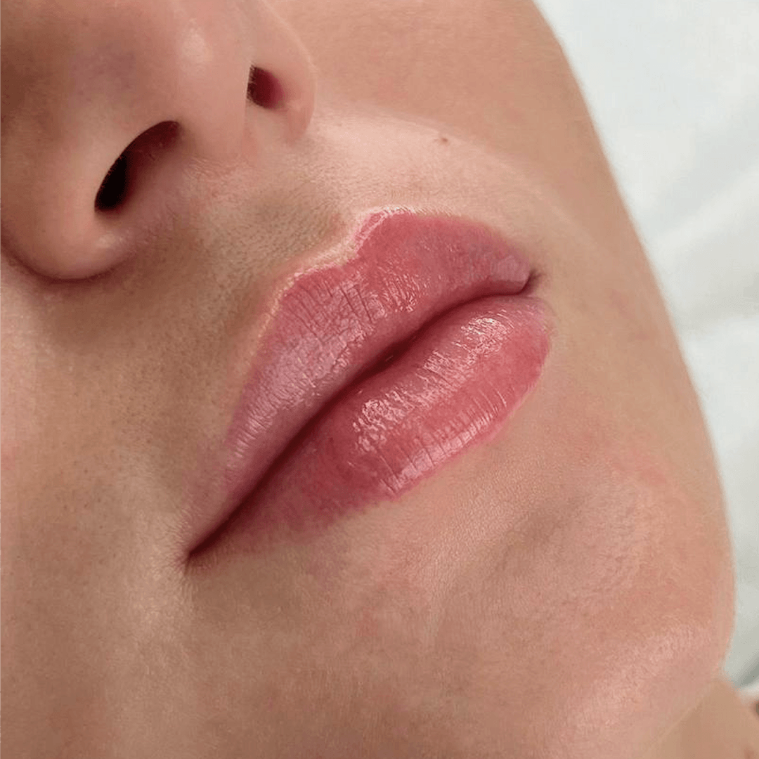 Результат Контурная пластика 1