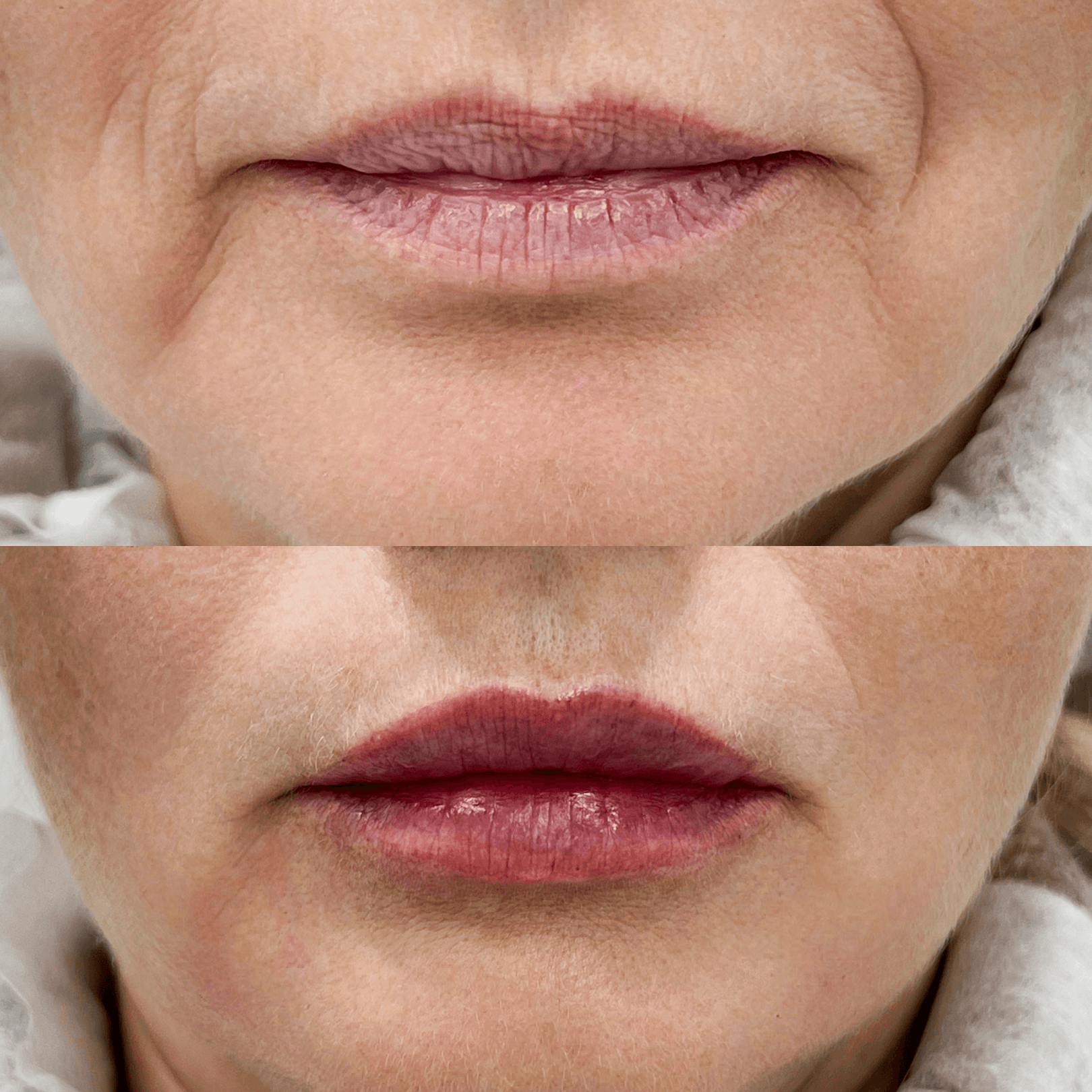 Результат Контурная пластика 4