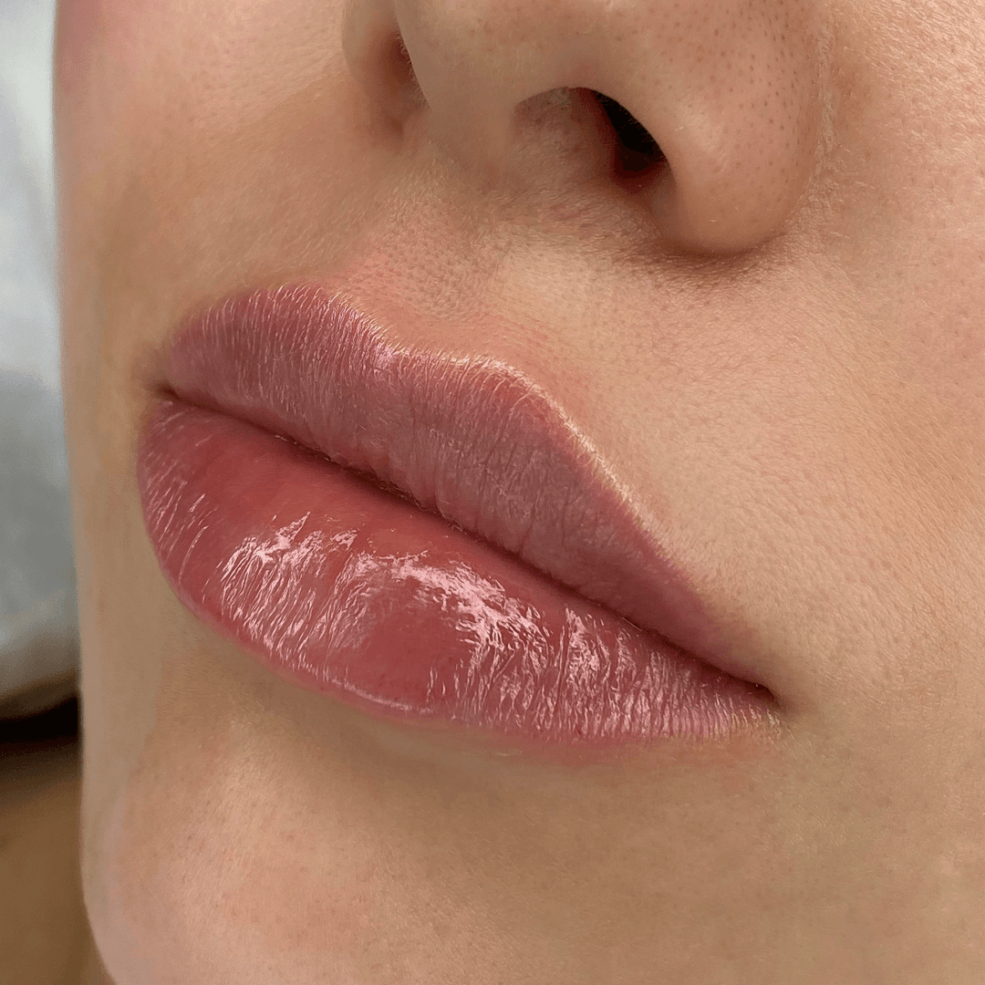 Результат Контурная пластика 5