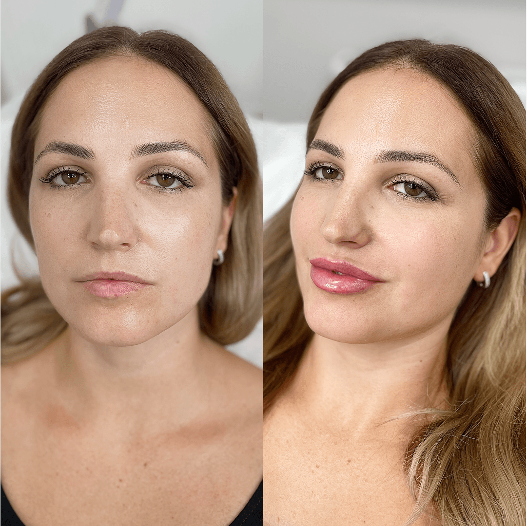 Результат Контурная пластика 3