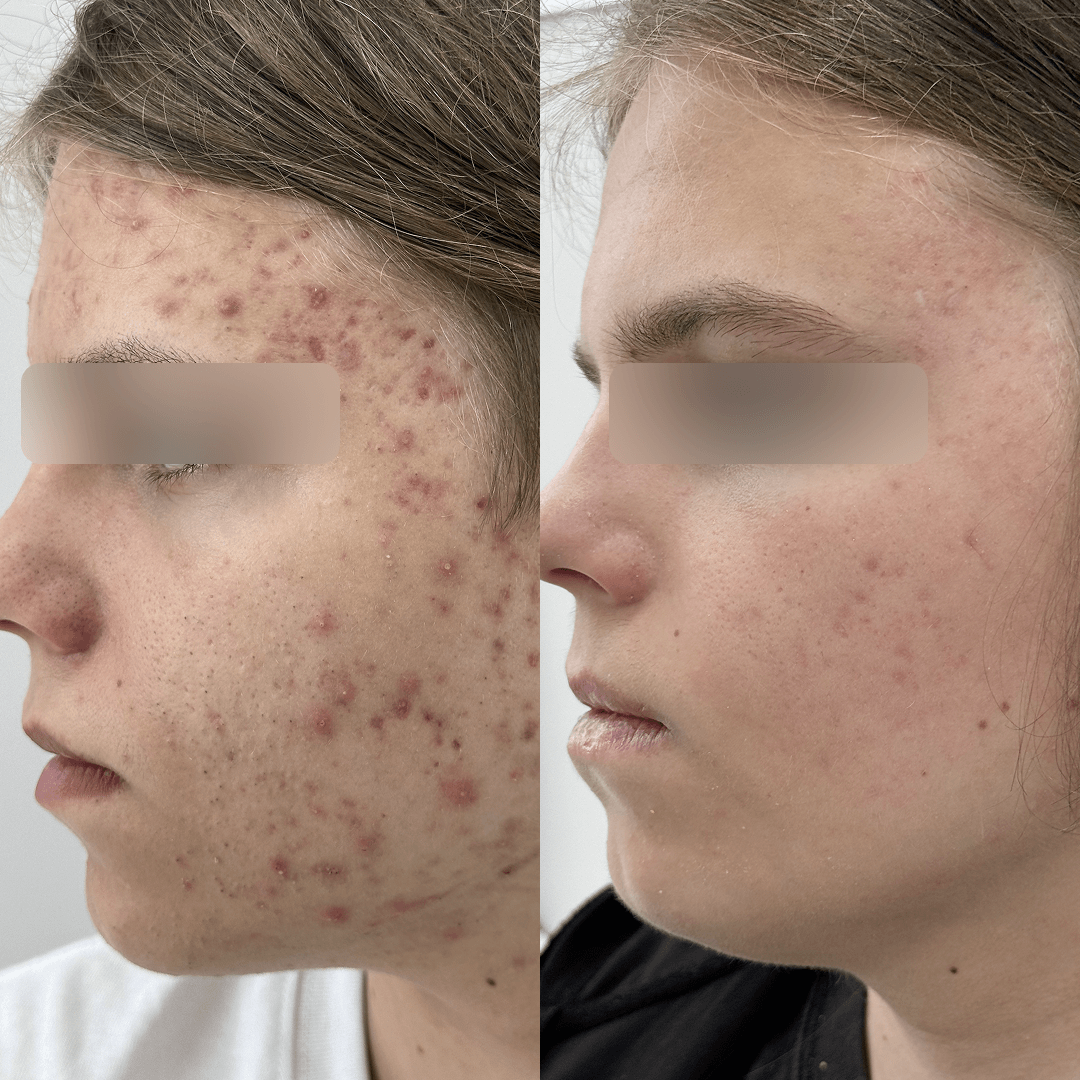 Результат Лечение акне 4