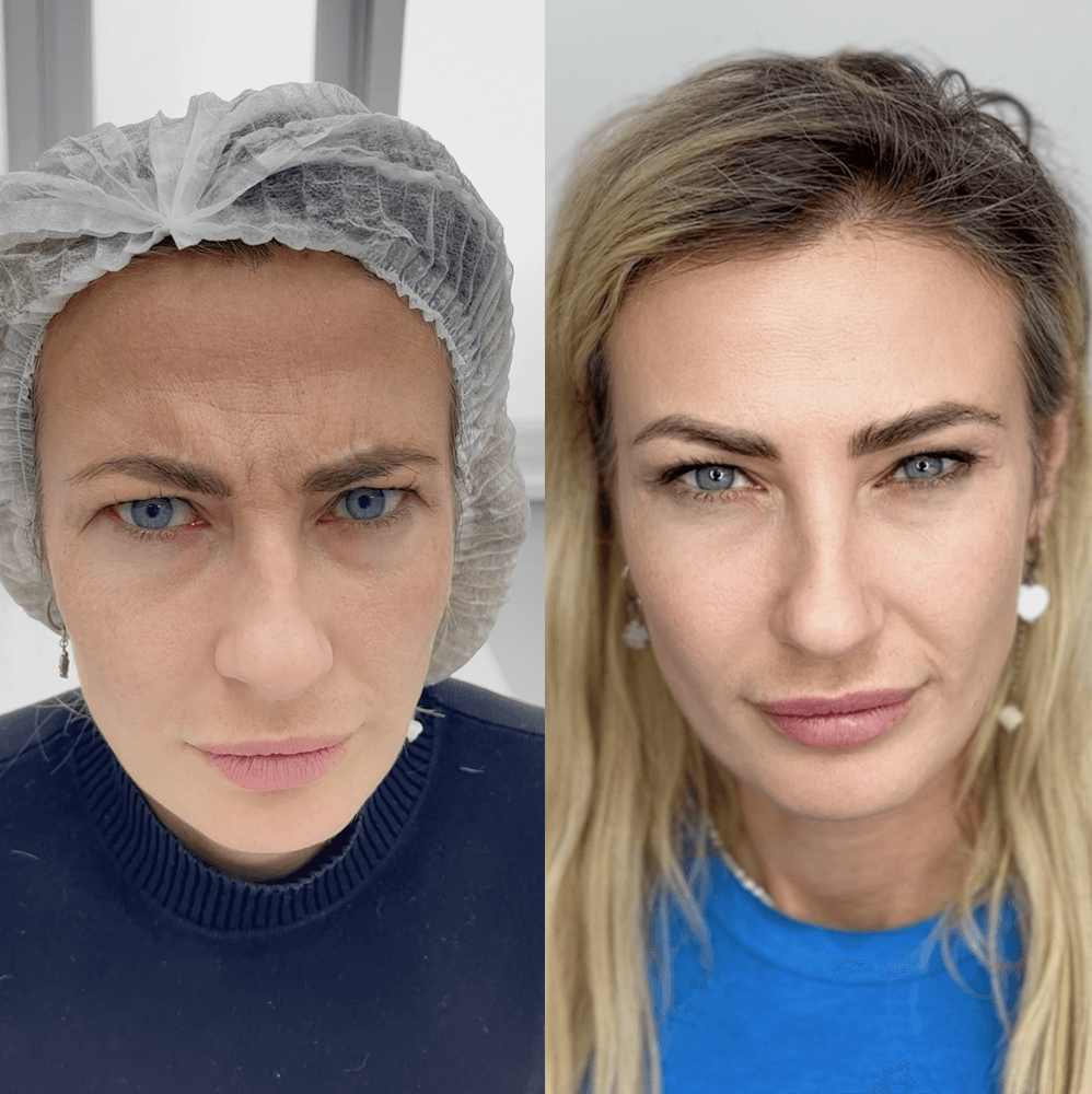Ботулинотерапия до процедуры
