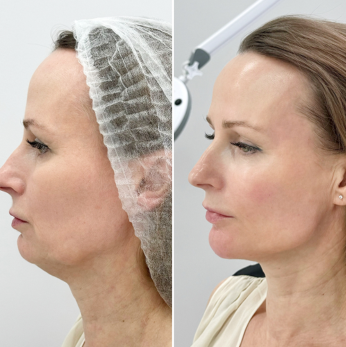 Full Face контурная пластика